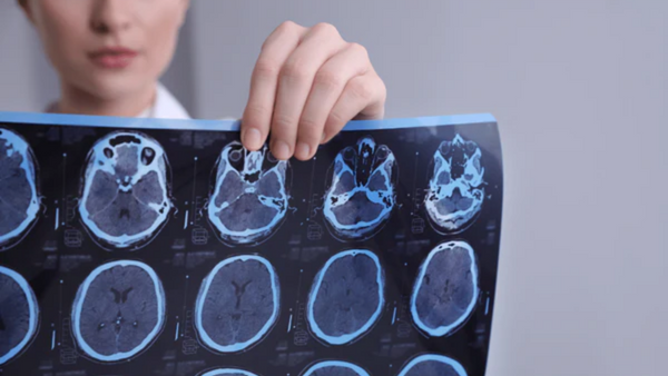 Multiple Sklerose: Diese Mikronährstoffe können die Behandlung unterstützen