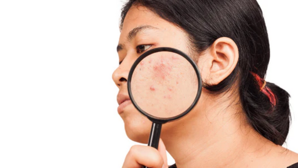 Akne: Wie die richtige Ernährung dein Hautbild verbessern kann
