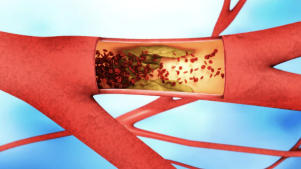 Was können Mikronährstoffe bei Arteriosklerose bewirken?