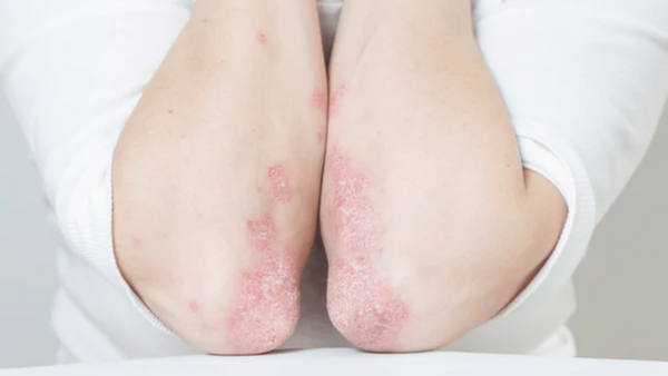 Mikronährstoffe bei Lupus erythematodes: Was können sie bewirken?